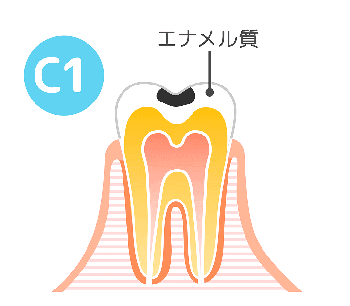 C1（エナメル質の虫歯）