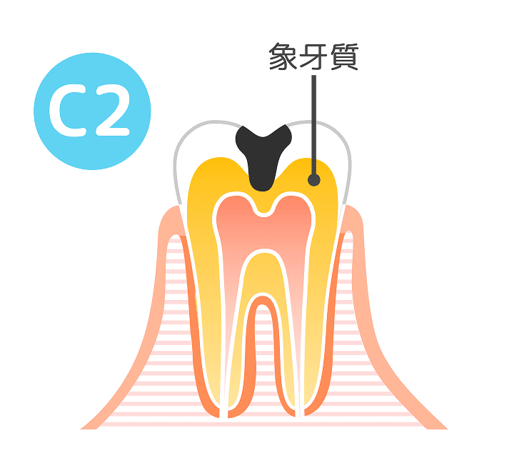 C2（象牙質の虫歯）