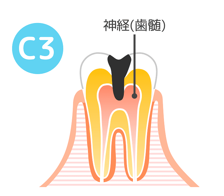 C3（神経に達した虫歯）