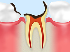 C4（歯根に達した虫歯）