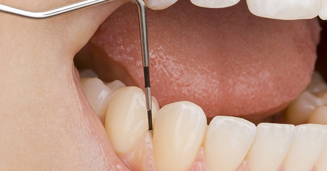 歯周病は歯を失う怖い病気です
