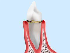 軽度歯周病